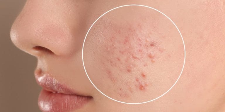 Acnee – Cauze, Tratamente, Remedii Naturale și Sfaturi Locale
