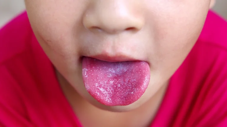 Scarlatina: Simptome, Cauze, Tratament și Prevenție Scarlatina